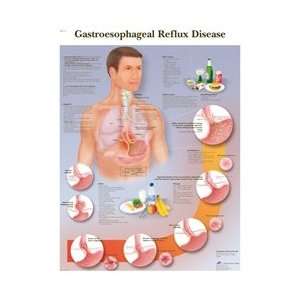 Reflux Disease   Anatomical Chart  Industrial & Scientific